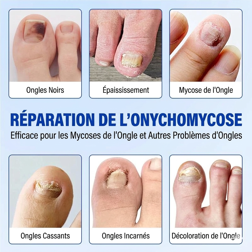 Patchs réparateurs pour ongles mycosés