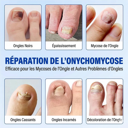Patchs réparateurs pour ongles mycosés