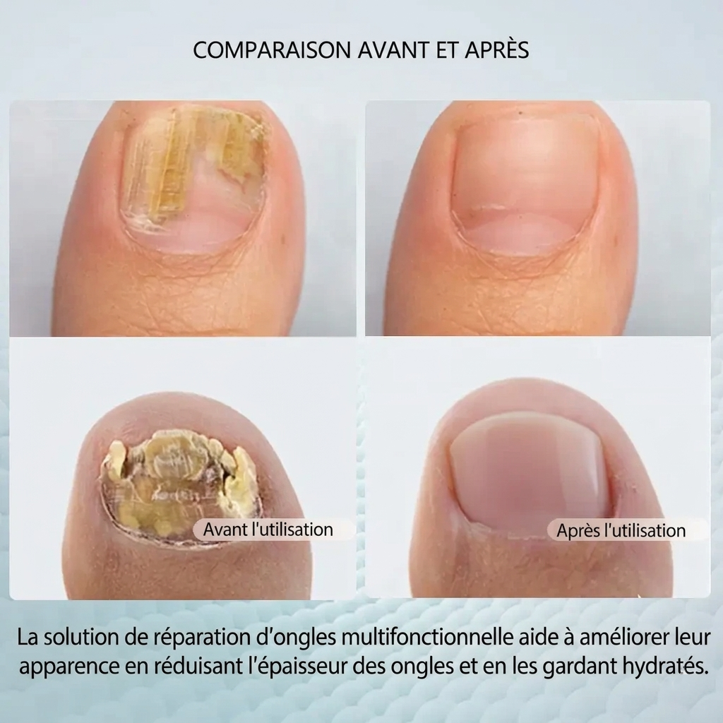 Vereuse™ Sérum réparateur pour ongles