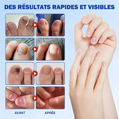 Patchs réparateurs pour ongles mycosés
