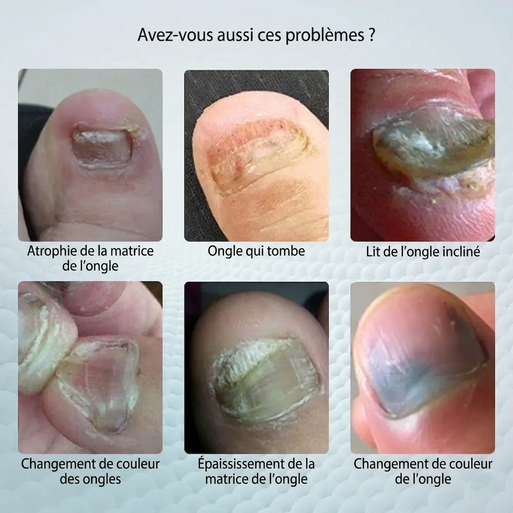 Vereuse™ Sérum réparateur pour ongles