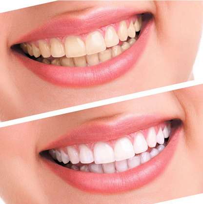 Kit de Blanchiment des Dents – Sourire Éclatant