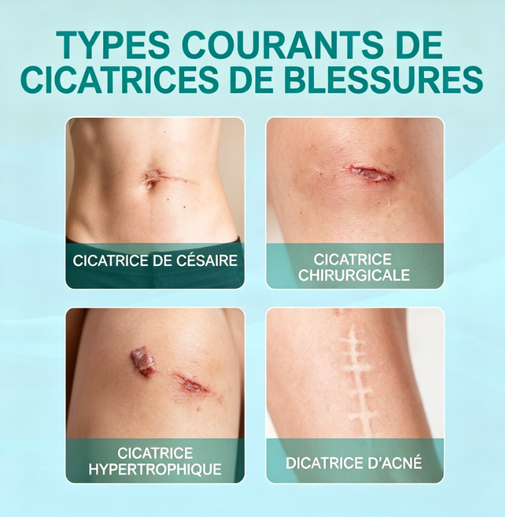 Spray pour cicatrices South Moon – Qualité premium