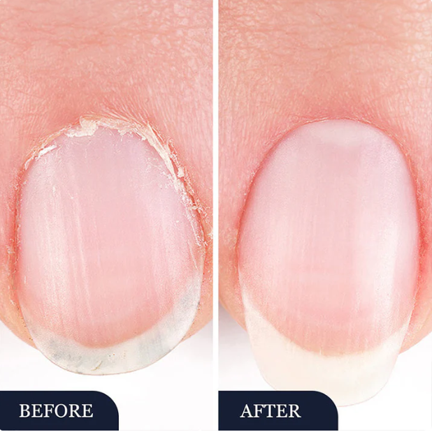 Stylo de traitement contre les mycoses des ongles — Adapté aux ongles abîmés