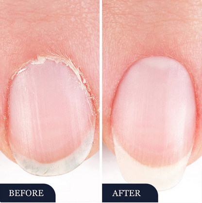 Stylo de traitement contre les mycoses des ongles — Adapté aux ongles abîmés