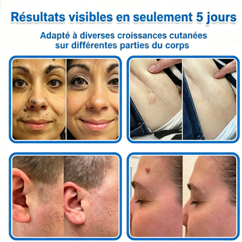 Patch hydrocolloïde à micro-aiguilles 2-en-1 pour l'élimination des grains de beauté en relief, de l'acné, des verrues planes et des acrochordons.