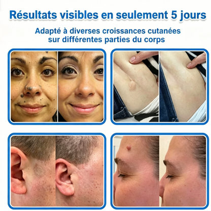 Patch hydrocolloïde à micro-aiguilles 2-en-1 pour l'élimination des grains de beauté en relief, de l'acné, des verrues planes et des acrochordons.