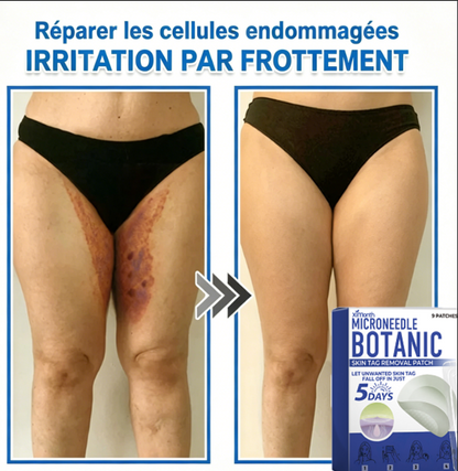 Patch hydrocolloïde à micro-aiguilles 2-en-1 pour l'élimination des grains de beauté en relief, de l'acné, des verrues planes et des acrochordons.