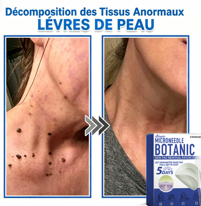 Patch hydrocolloïde à micro-aiguilles 2-en-1 pour l'élimination des grains de beauté en relief, de l'acné, des verrues planes et des acrochordons.