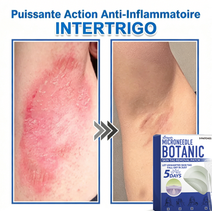 Patch hydrocolloïde à micro-aiguilles 2-en-1 pour l'élimination des grains de beauté en relief, de l'acné, des verrues planes et des acrochordons.